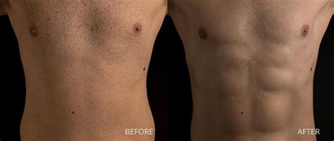 male liposuction miami|Male Liposuction Miami